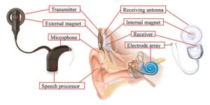 Anatomical diagram showing cochlear implant parts: transmitter, external magnet, microphone, speech processor, receiving antenna, internal magnet, receiver, and electrode array
